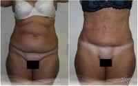 Tummy tuck procedure before and afterTummy tuck procedure before and after