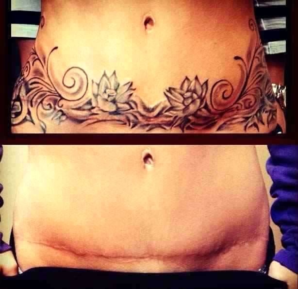 before and after tummy tuck with stretch marks