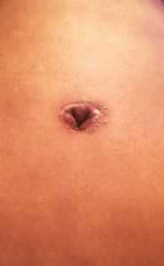 Belly button after abdominoplasty