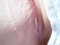 Inflammation of the tummy tuck wound