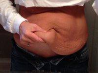 Mini Abdominoplasty Procedure Pictures Results With Dr Jules Walters