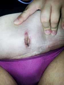 Navel after tummy tuck