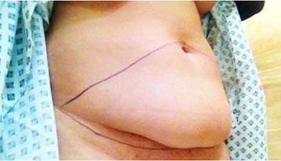 Amazing Tummy Tuck with Internal Corset Muscle Repair Done by the