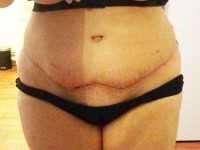 Tummy tuck in Indianapolis
