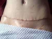 Abdominoplasty scar Oklahoma City