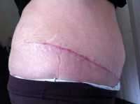 Abdominoplasty scar in Thailand