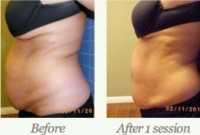 Beaty tek non surgical tummy tuck after 1 session
