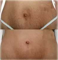 Before and after laser tummy tuck