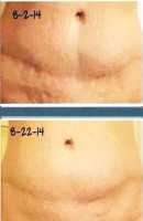 items yoy need before and after tummy tuck surgery