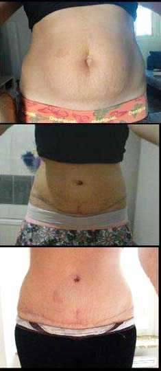 postpartum tummy tuck before and after
