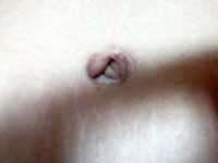 Belly button after tummy tuck