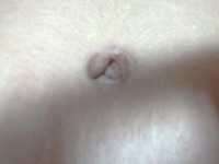 Belly button after tummy tuck in Costa Rica