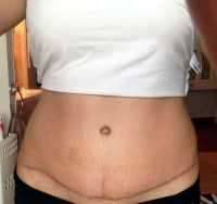 Cost of tummy tuck surgery