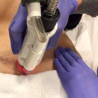 Fraxel For Scars After Tummy Tuck