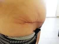 Honolulu abdominoplasty scar
