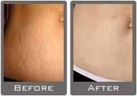 Laser tummy tuck pictures