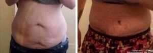 My before and after tummy tuck