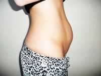 My belly before tummy tuck in Nothern Virginia