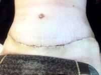 Scar tummy tuck after baby