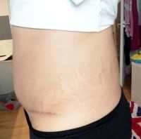 Tummy tuck after baby