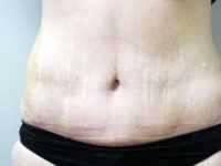 Tummy tuck in Knoxville
