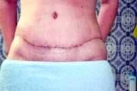 What is tummy tuck scar
