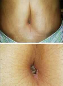 belly button after tummy tuck