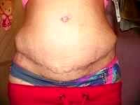 cosmetic surgery tummy tuck cost