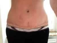 how much cost a tummy tuck