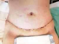 Tummy tuck scar after baby