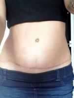 tummy tuck scars picture after 2 years