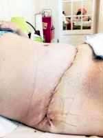 tummy tuck surgery after baby