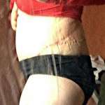 Abdominoplasty scar picture