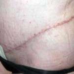 Abdominoplasty scars gallery