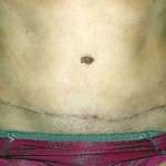 Abdominoplasty scars image