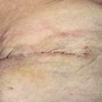 Abdominoplasty scars images