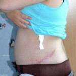 Abdominoplasty scars photo