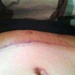 Abdominoplasty surgery scars picture