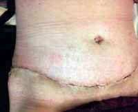 After free tummy tuck surgery