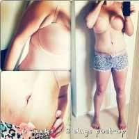 After liposuction and tummy tuck
