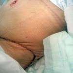 After tummy tuck result