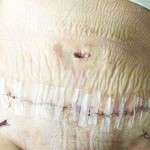 Before and after tummy tuck scars (2)