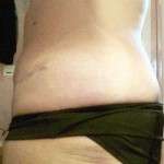 Before and after tummy tuck scars (3)