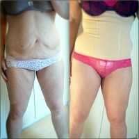 Before and tummy tuck and liposuction