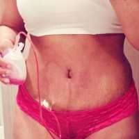 Drains after abdominoplasty