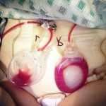Drains after tummy tuck
