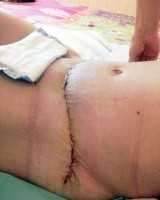 Free tummy tuck surgery scar