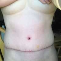 How much for a abdominoplasty