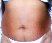 How much for a tummy tuck image