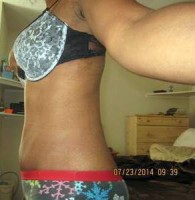 How much for a tummy tuck surgery 2